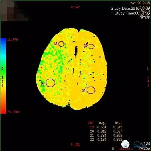 颅内动脉狭窄介入治疗研究,颅内血管cta副作用