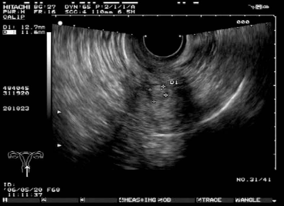 子宫圆韧带肌瘤的超声表现,子宫肌壁间肌瘤超声影像