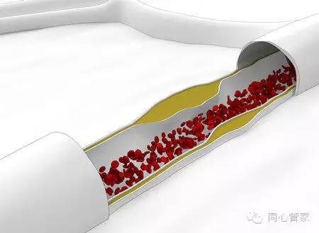 血汗管软斑块危险,血汗管软斑块和硬斑块的区别