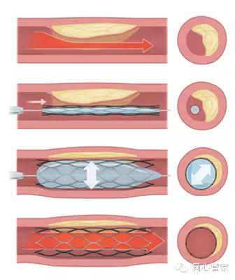 血汗管软斑块危险,血汗管软斑块和硬斑块的区别
