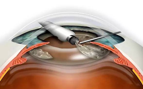 白内障可防可控吗,白内障如何预防和治疗