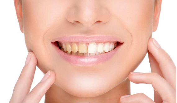 牙齿黄用牙齿美白仪怎么样,牙齿黄如何快速美白