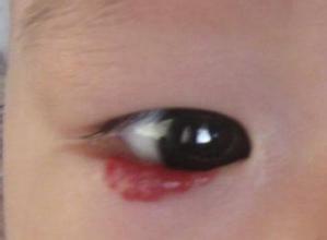 血管瘤和红斑区别,红色小斑是血管瘤吗