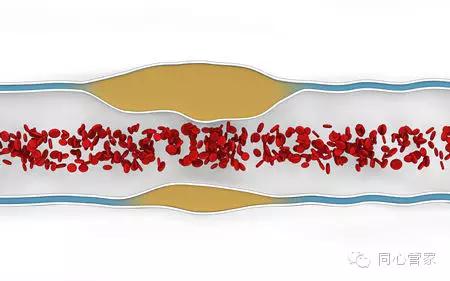 血汗管软斑块危险,血汗管软斑块和硬斑块的区别