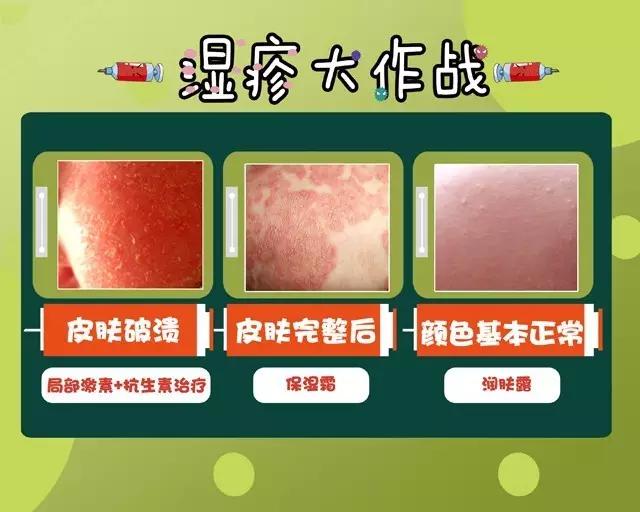 湿疹宝宝可以洗澡吗崔玉涛,崔玉涛治疗湿疹的最佳方法