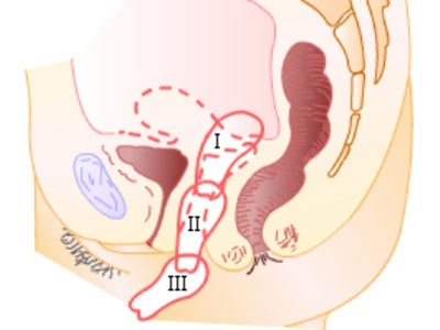 子宫脱垂对老年女性有哪些危害？