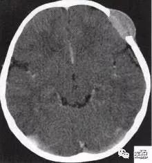 3岁小孩头上有个包做ct说是骨瘤,小孩头部ct为什么会增加肿瘤几率