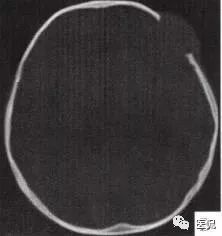 3岁小孩头上有个包做ct说是骨瘤,小孩头部ct为什么会增加肿瘤几率