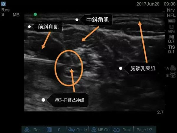 超声引导隐神经阻滞视频教学,超声引导下腰椎旁神经阻滞视频