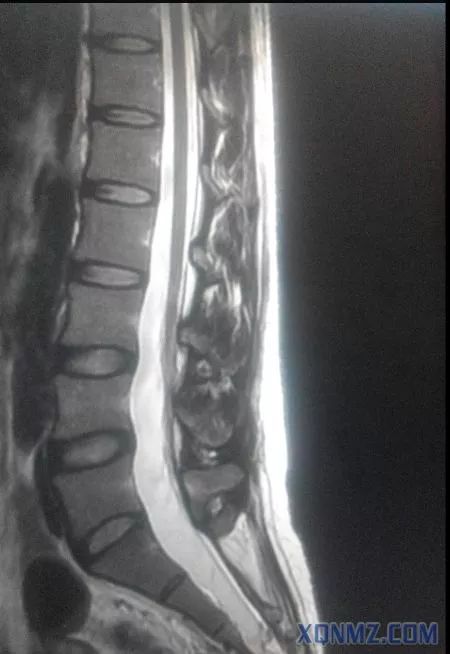 超声引导隐神经阻滞视频教学,超声引导下腰椎旁神经阻滞视频