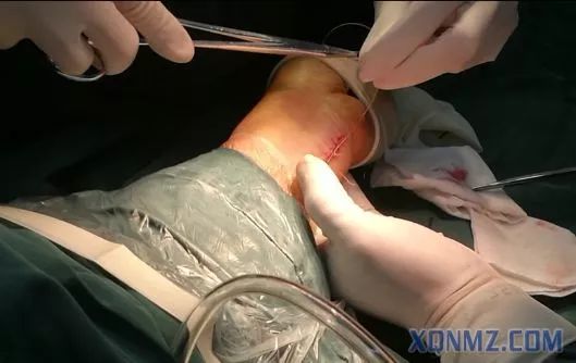 超声引导隐神经阻滞视频教学,超声引导下腰椎旁神经阻滞视频