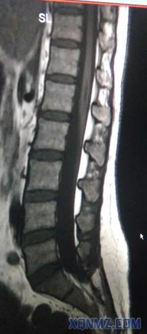 超声引导隐神经阻滞视频教学,超声引导下腰椎旁神经阻滞视频