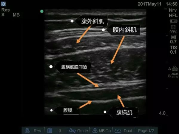 超声引导隐神经阻滞视频教学,超声引导下腰椎旁神经阻滞视频