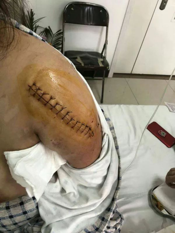 超声引导隐神经阻滞视频教学,超声引导下腰椎旁神经阻滞视频