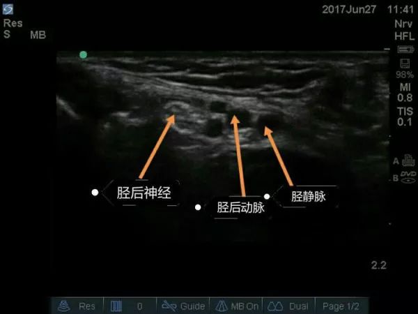超声引导隐神经阻滞视频教学,超声引导下腰椎旁神经阻滞视频