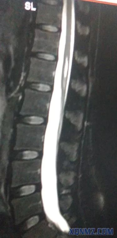 超声引导隐神经阻滞视频教学,超声引导下腰椎旁神经阻滞视频