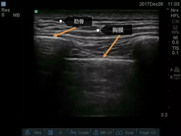 超声引导隐神经阻滞视频教学,超声引导下腰椎旁神经阻滞视频