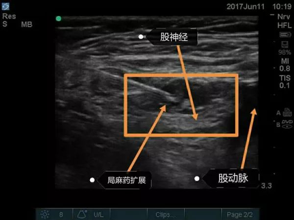 超声引导隐神经阻滞视频教学,超声引导下腰椎旁神经阻滞视频
