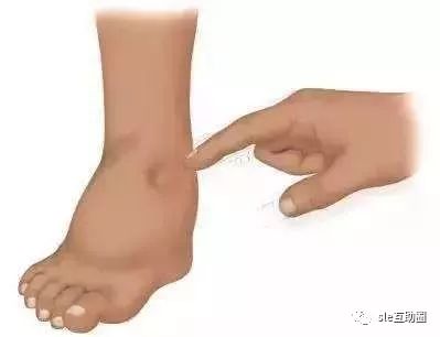 水肿肾炎患者的饮食和关注事项,简述肾病水肿的护理