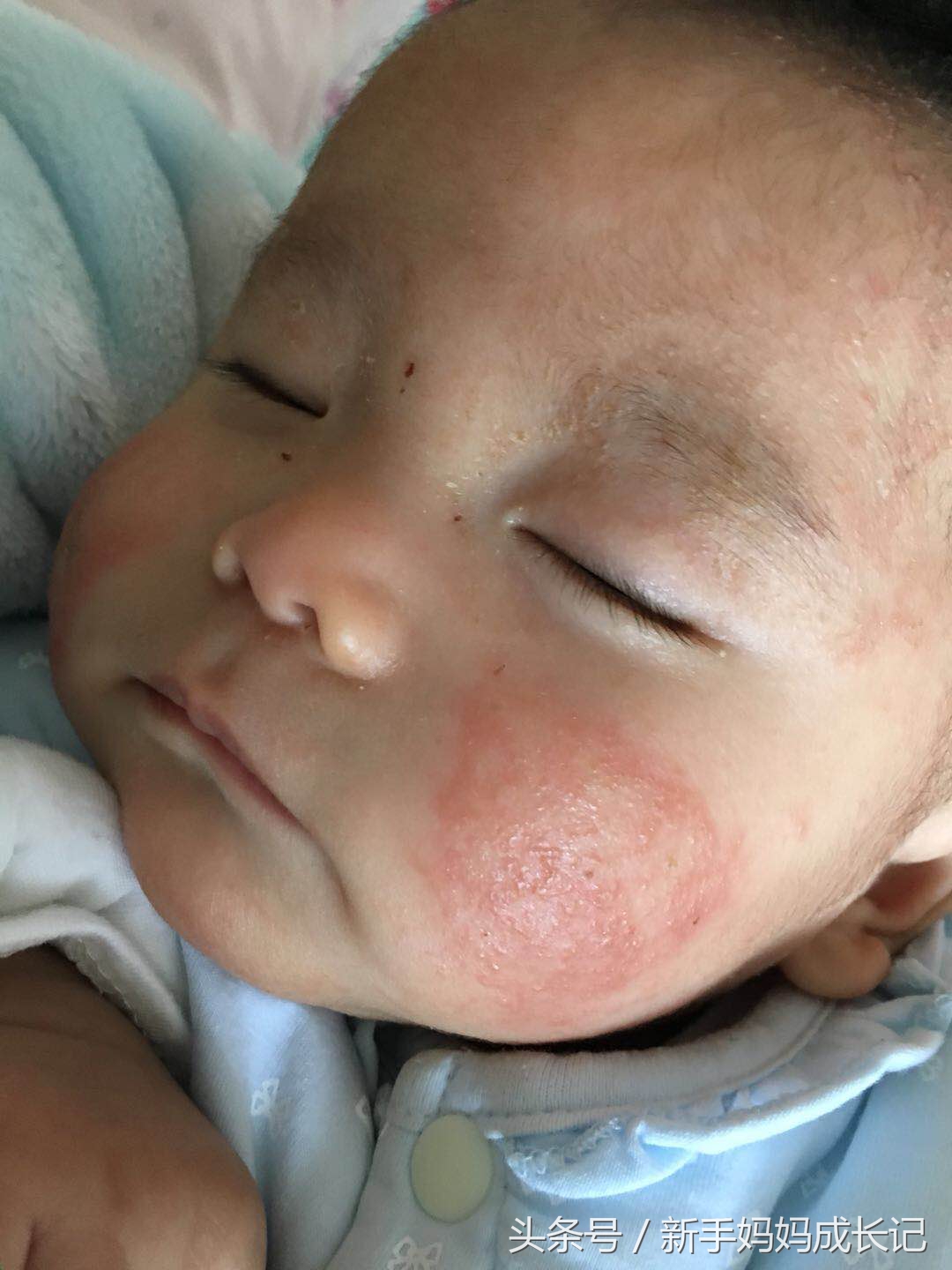 宝宝湿疹的样子有哪些,宝宝湿疹的前期症状是怎样的