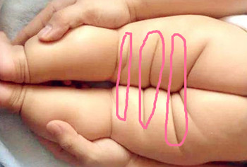 宝宝臀纹不对称有必要打b超吗,宝宝臀纹不对称做b超