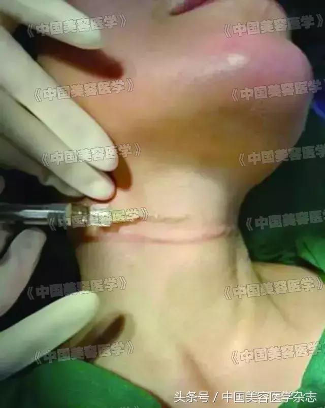 颈纹很深怎么办二十岁,玻尿酸可以祛除颈纹吗