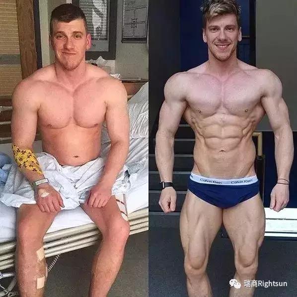 健美冠军体脂率是多少,26岁健美冠军小腿静脉爆裂