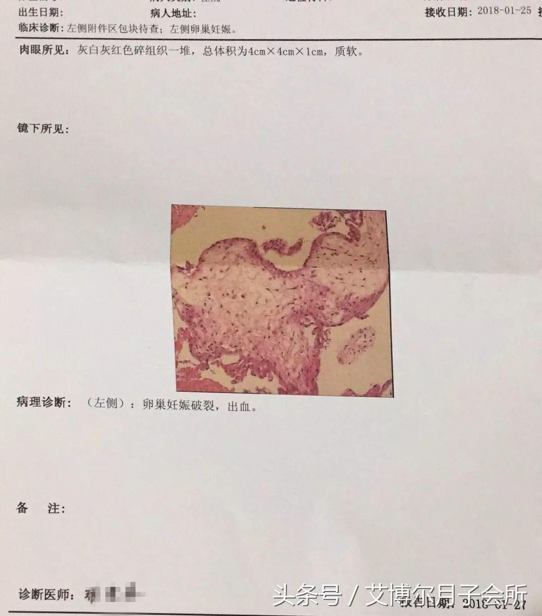 宁波女子遇罕见宫外孕，胎儿竟长在卵巢！发生率仅5万分之一！