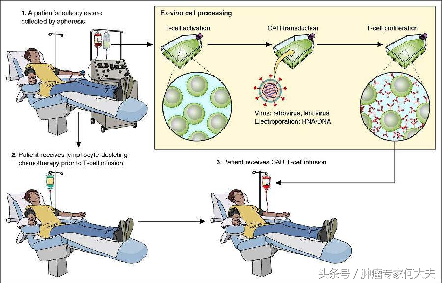 cart免疫疗法成功治疗肿瘤案例,car-t细胞疗法治疗实体瘤