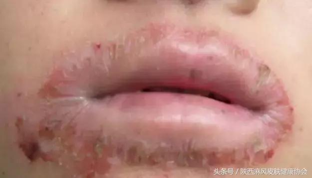 唇炎患者怎么保湿皮肤好,唇炎唇部干燥的厉害如何滋润