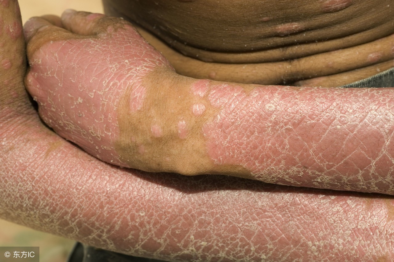 遗传性鱼鳞病怎么治疗,遗传性鱼鳞病能治好吗