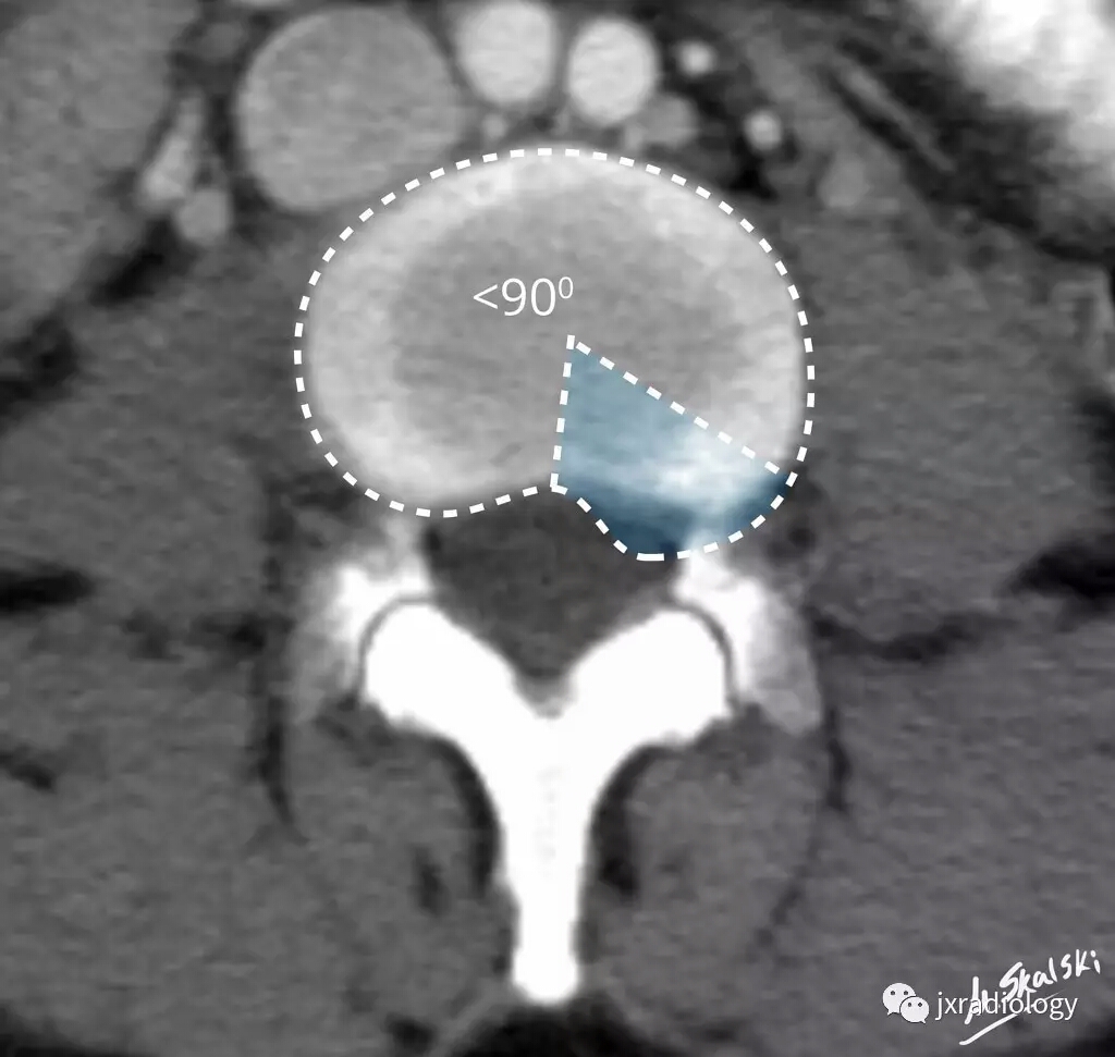 腰椎间盘怎么判断膨出还是突出,腰椎间盘膨出的最佳锻炼方法图