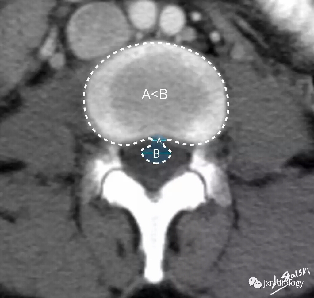 腰椎间盘怎么判断膨出还是突出,腰椎间盘膨出的最佳锻炼方法图