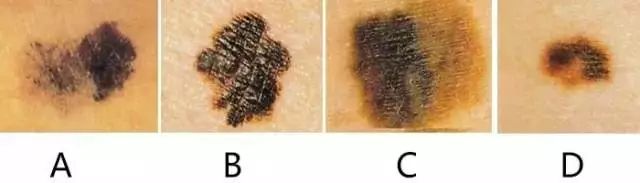 黑色素痣病理检测鳞状上皮病变,什么样的痣需要做病理