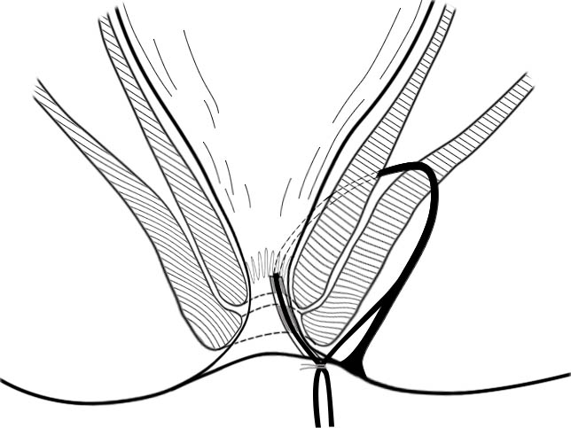 肛肠最新技术,人活一世难免会遇到各种糟心的事