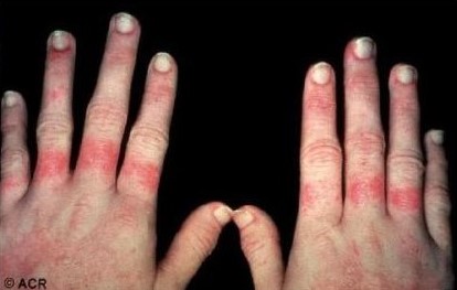 糖皮质激素的抗炎作用机制图解,糖皮质激素可以抗休克吗