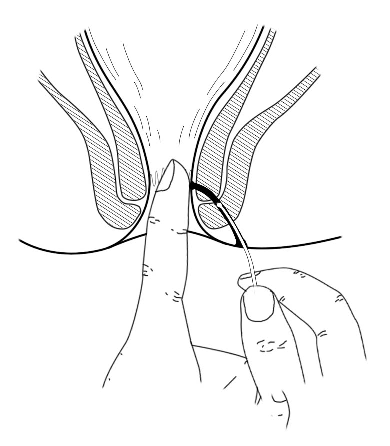 肛肠最新技术,人活一世难免会遇到各种糟心的事
