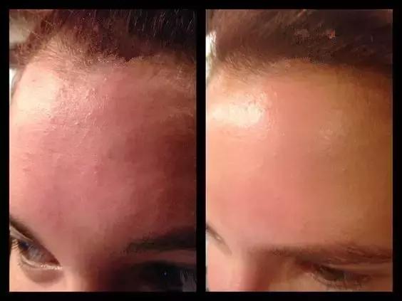 AnnaG教你整｜丰额头，能增加运气吗？