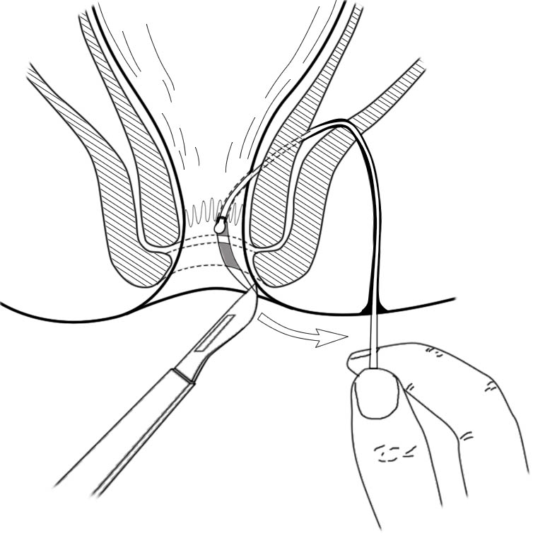 肛肠最新技术,人活一世难免会遇到各种糟心的事