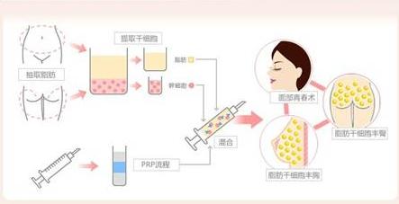 脂肪移植术后需要关注什么,自体脂肪移植填充泪沟多久恢复