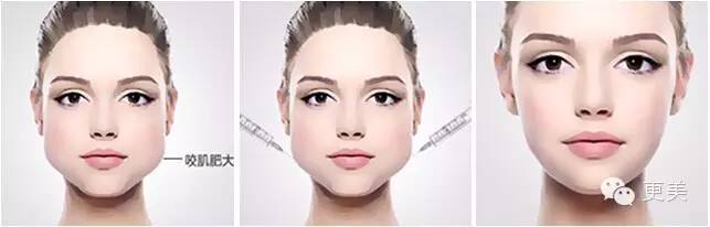 瘦脸针只打一针管用吗,瘦脸针只瘦咬肌吗