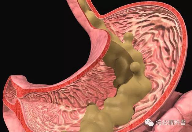 胃胀反酸烧心吃什么药,反酸烧心是怎么一回事如何治疗