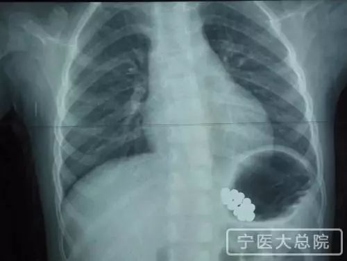 小孩误吞三颗磁力珠,3岁男童误吞10多颗磁力珠