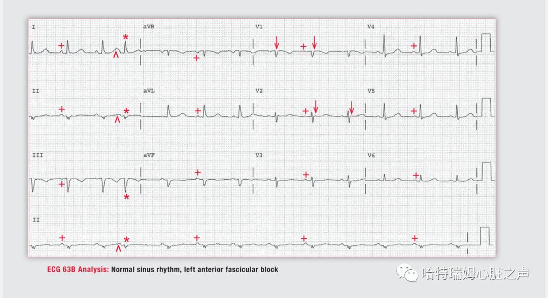 「读心有术」329期：电轴极度左偏，病因有两种