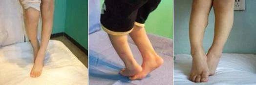 宁波市脑瘫患儿,浙江宁波哪里有脑瘫人士托养机构