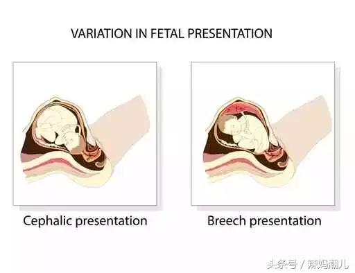 臀位胎儿入盆是什么感觉,胎儿入盆会有想拉大便的感觉吗