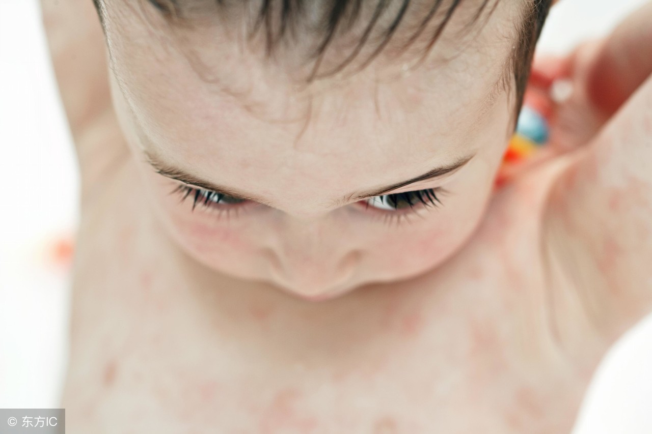 三岁宝宝湿疹一直反复怎么办,宝宝冬天长湿疹怎么处理