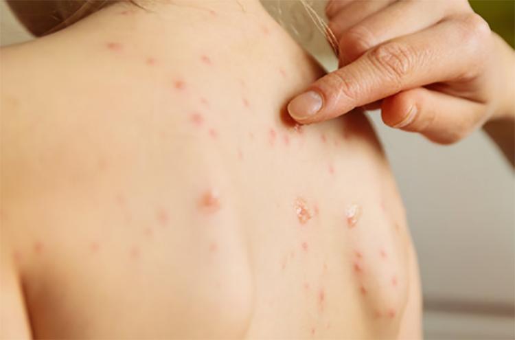 前胸和后背长毛囊炎的原因,毛囊炎引起前胸后背长痘痘原因