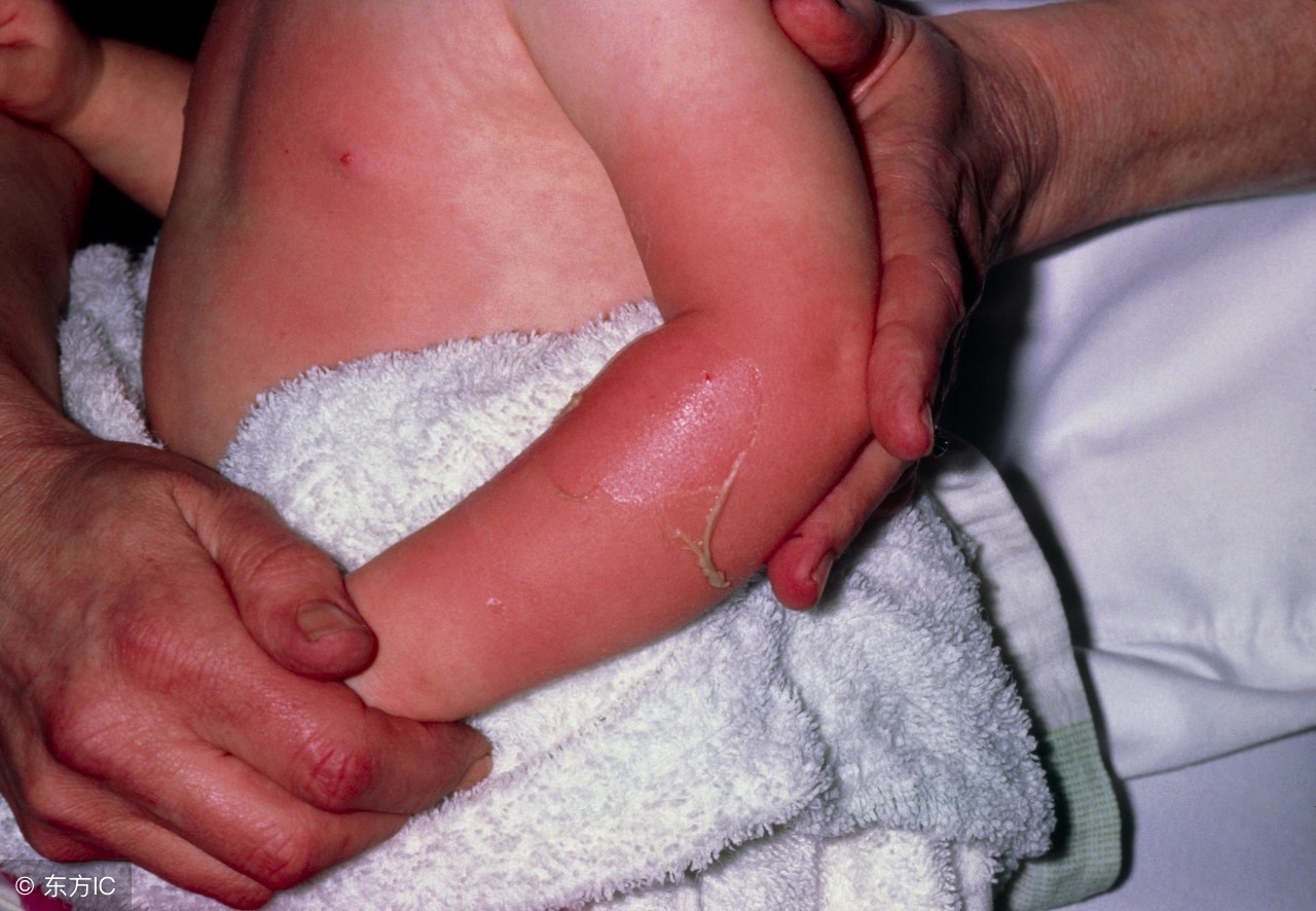 正确处理烫伤或烧伤的方法是,烫伤抹酱油的正确方法