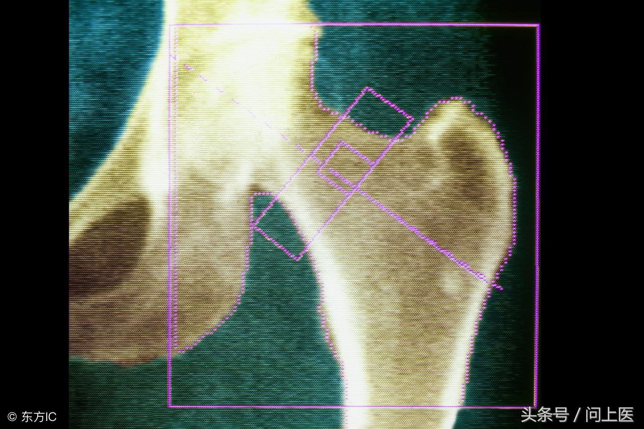 骨密度测试准确率高吗,3种食物多吃增强骨密度